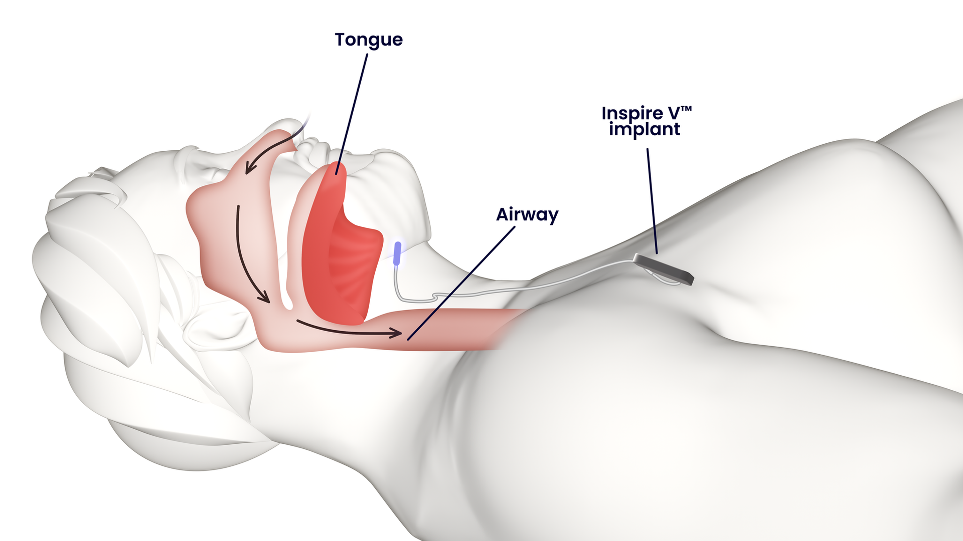 Open airway with inspire implant