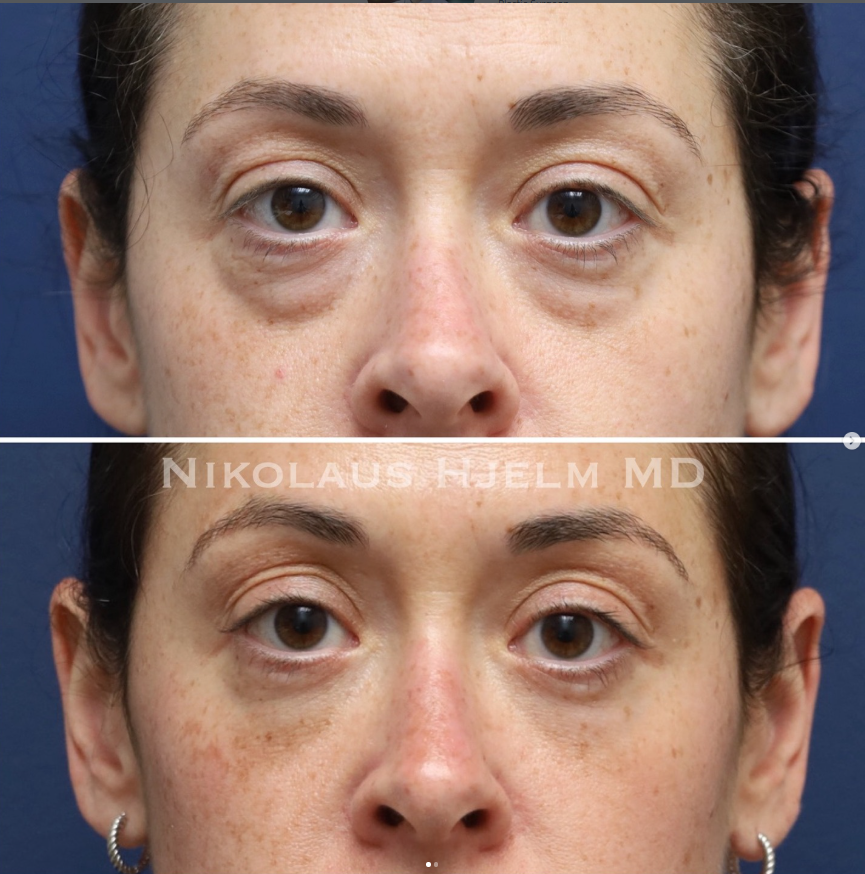 Lower Blepharoplasty