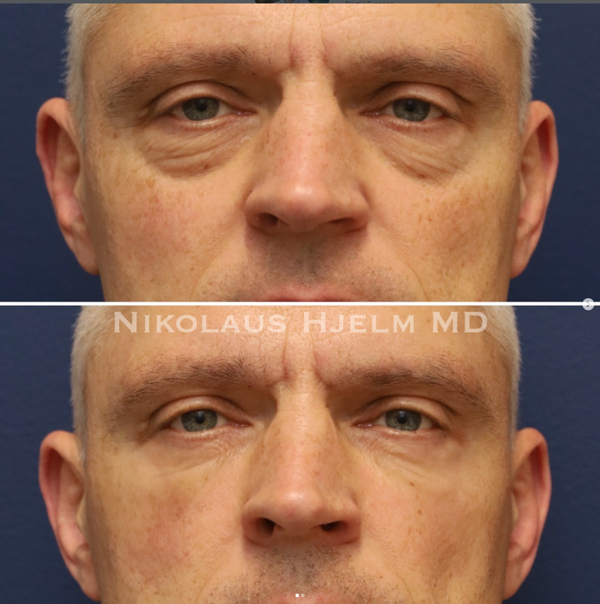 Lower Blepharoplasty