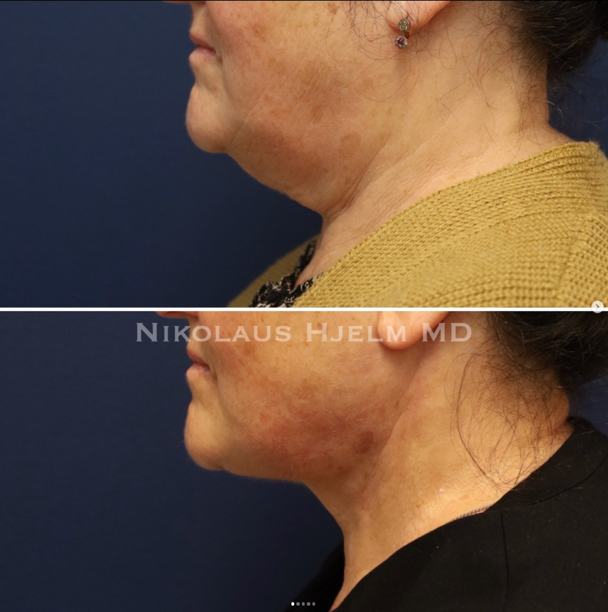 Neck Lift