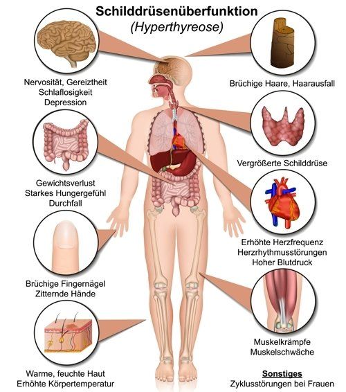 Das sind die Symptome bei Schilddrüsenüberfunktion