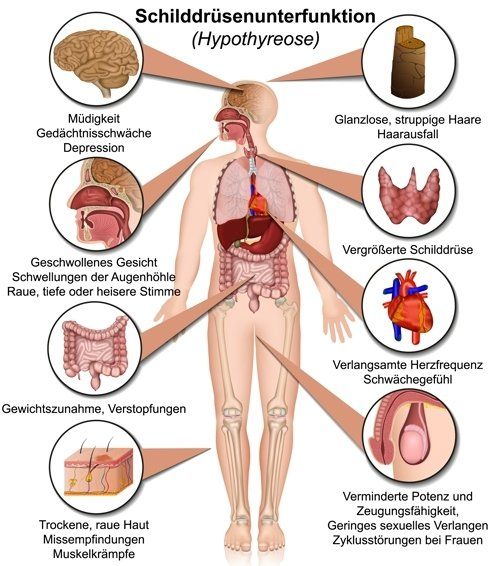 Das sind die Symptome bei Schilddrüsenunterfunktion
