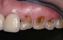 A close up of a person 's teeth with holes in them.