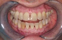 A close up of a person 's mouth with a mouth guard.