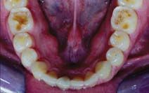 A close up of a person 's mouth with a lot of teeth.