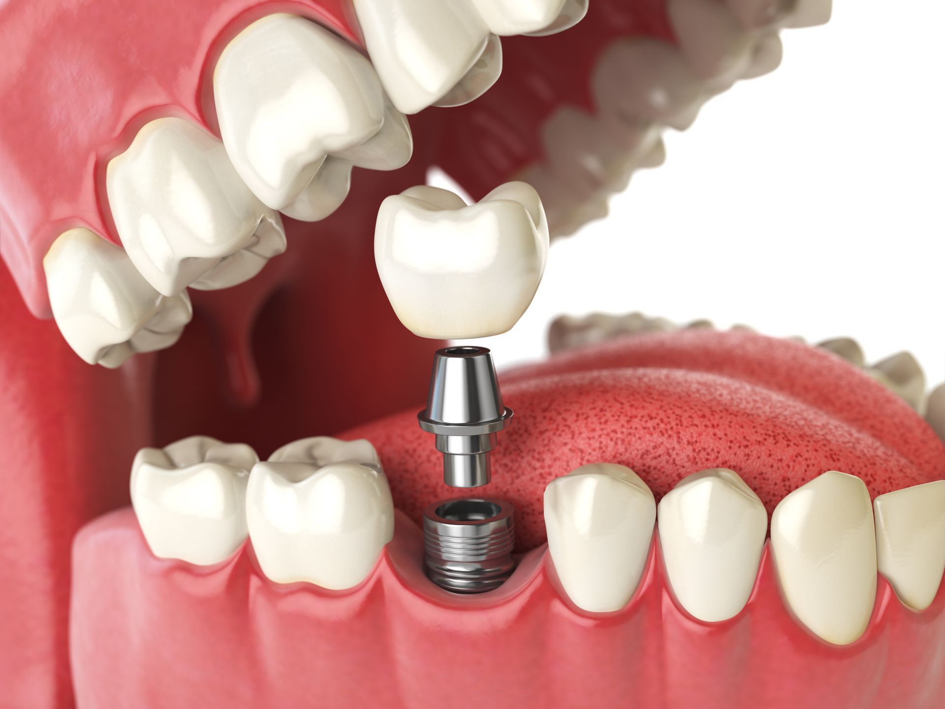 Dental implant model showing a tooth crown on a metal implant in a red gum model