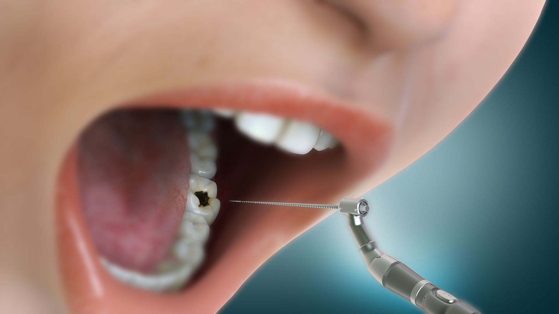 Close-up of a mouth being examined by a dental drill and mirror, with lips parted and teeth visible