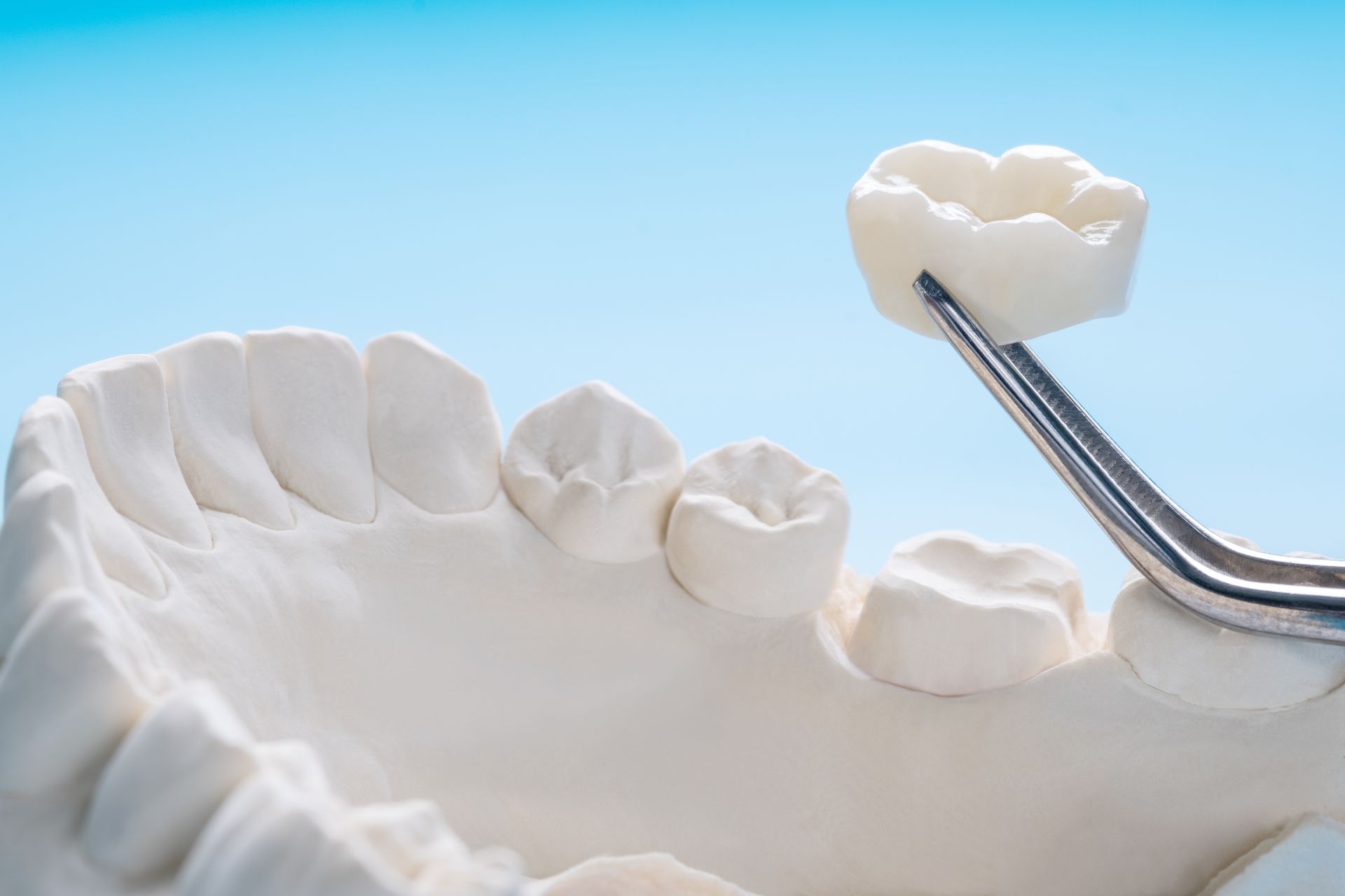 Dental crown held by tweezers over a white tooth mold against a blue background