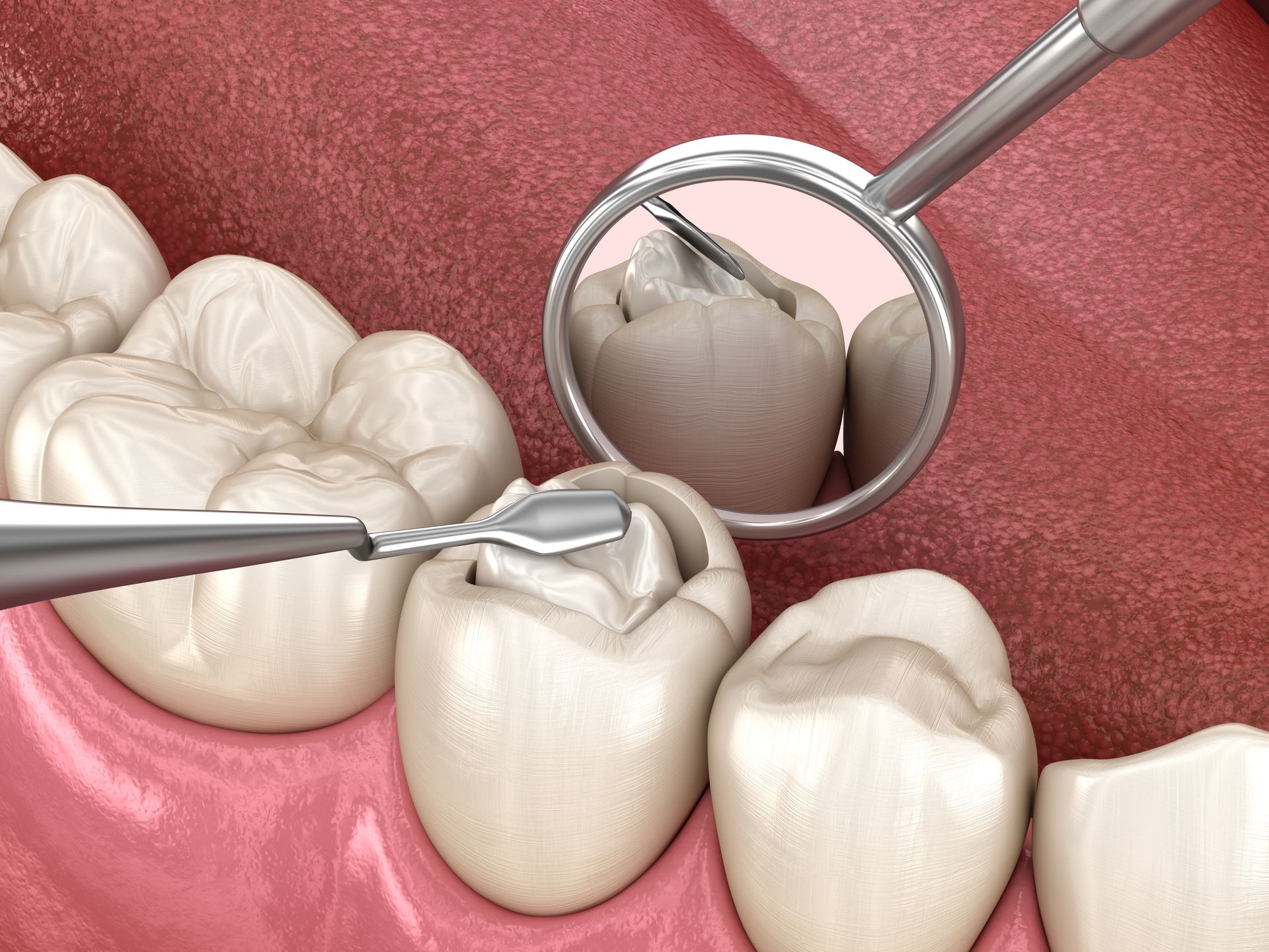 Dental exam showing a mirror and tool inspecting a molar with a cracked tooth filling
