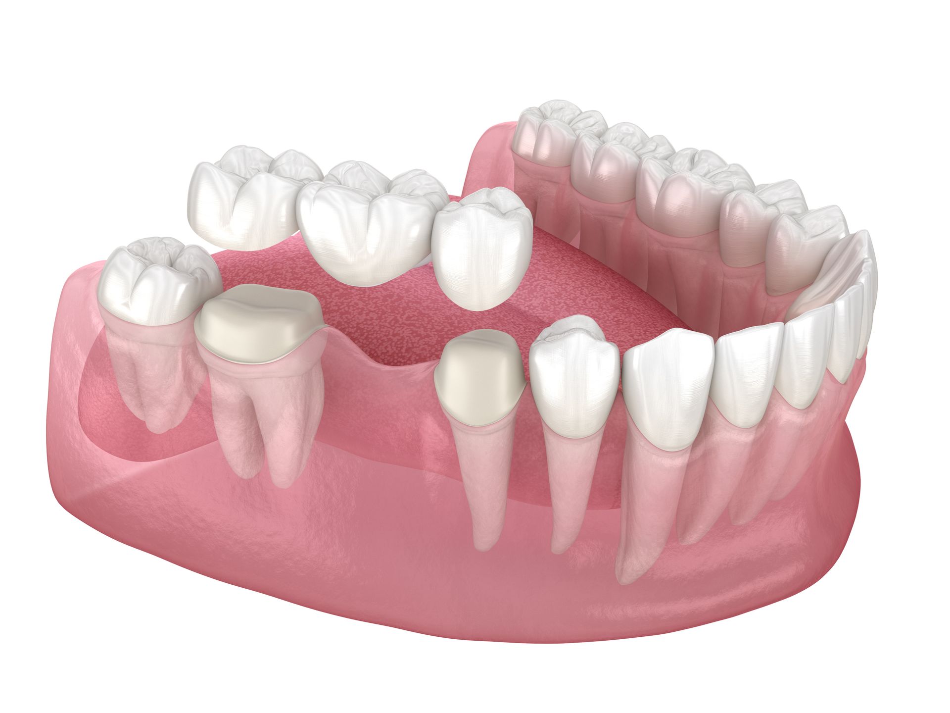 3D model of a human lower jaw with teeth and pink gums, showing several missing teeth