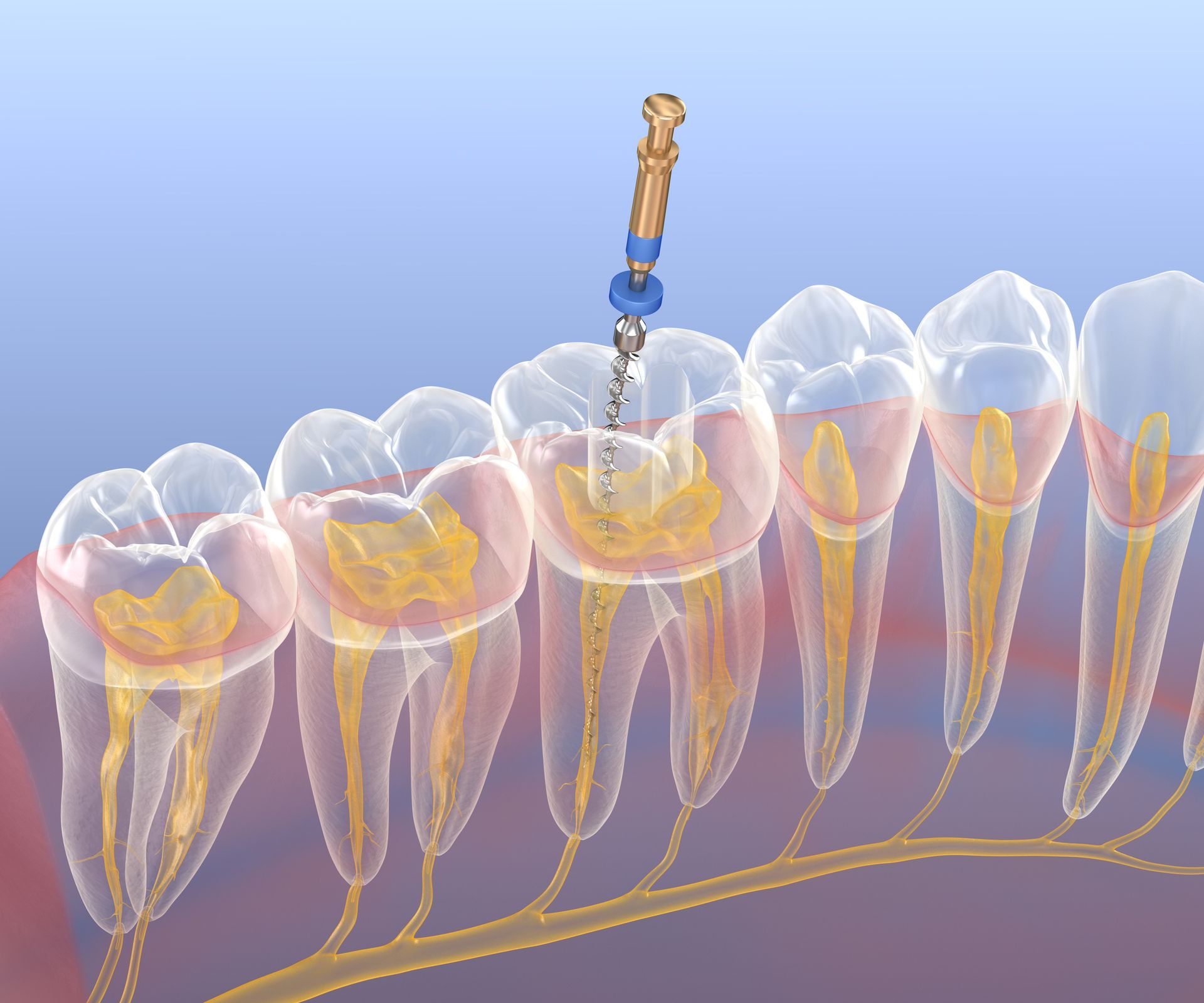 Dental tool drilling into a tooth cross-section with exposed roots and nerves, showing decay treatment