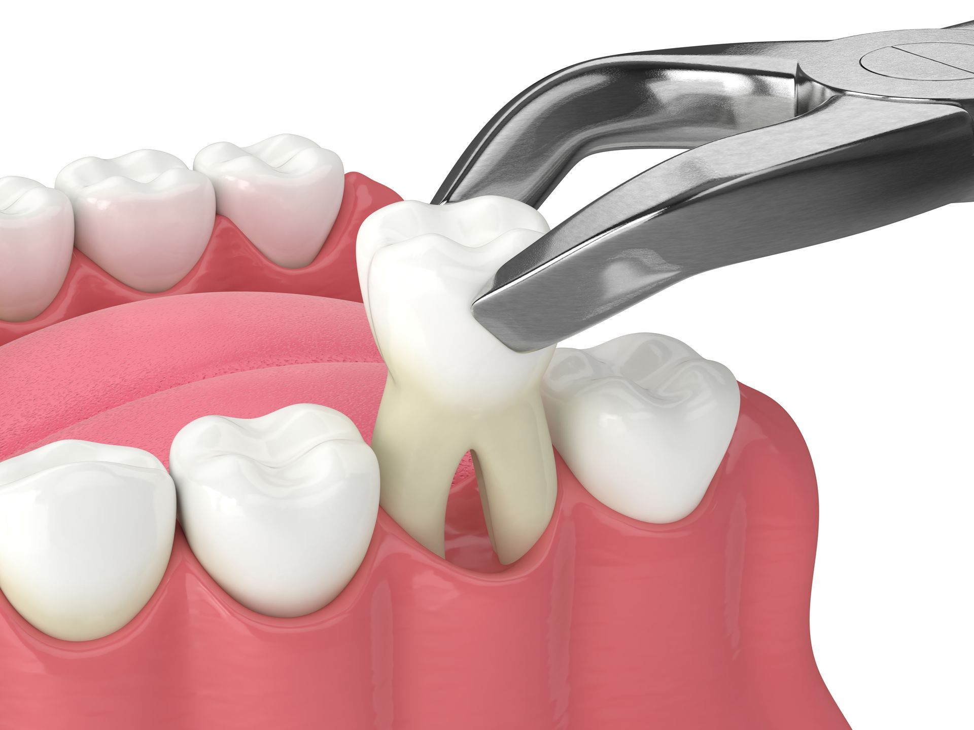 Dental forceps extracting a white tooth from pink gums next to other teeth