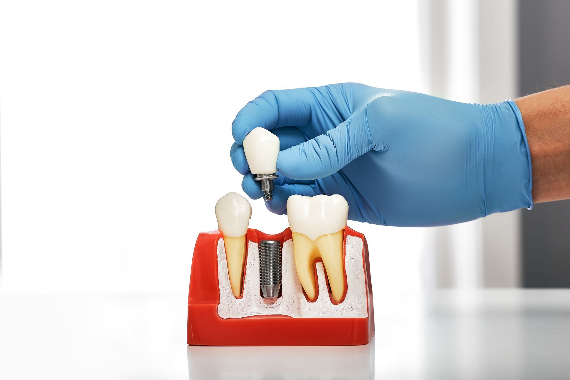 Blue-gloved hand placing a dental implant into a model jaw with teeth