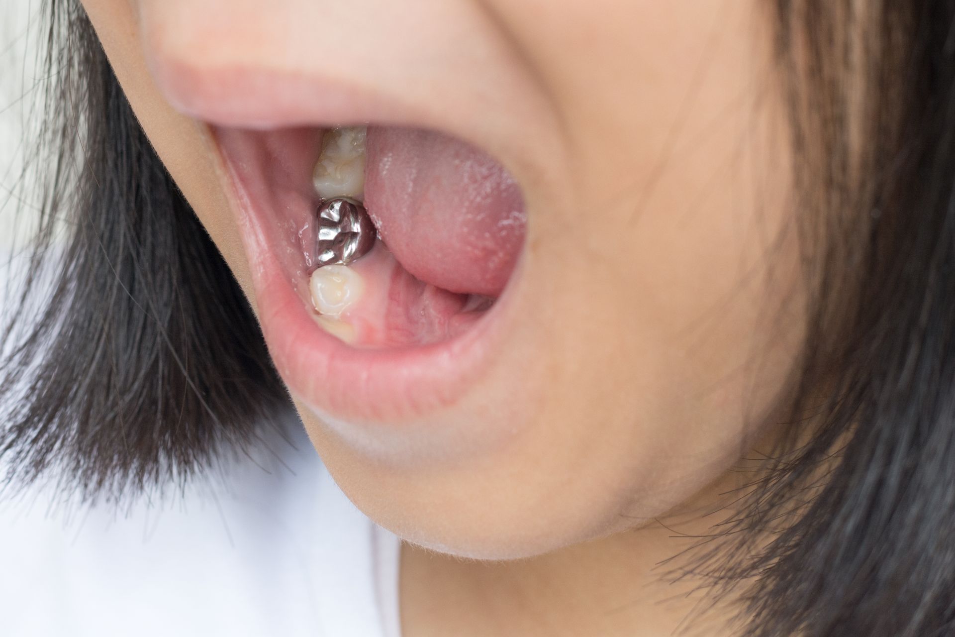 Close-up of an open mouth with a visible metal dental brace on the lower teeth.