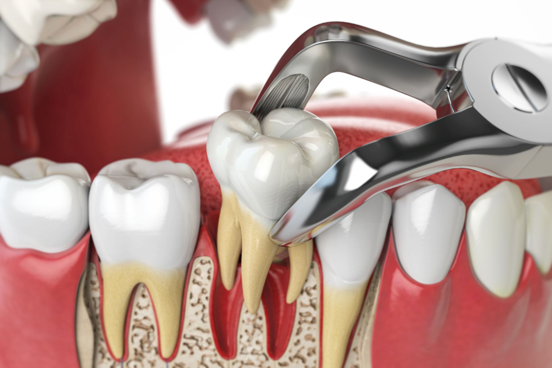 Dental extraction of a molar with forceps in a gum and tooth cross-section illustration