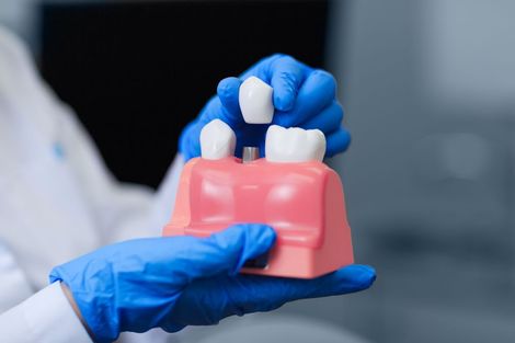 Dentist in blue gloves holding a model of teeth, showing implants in a medical setting.