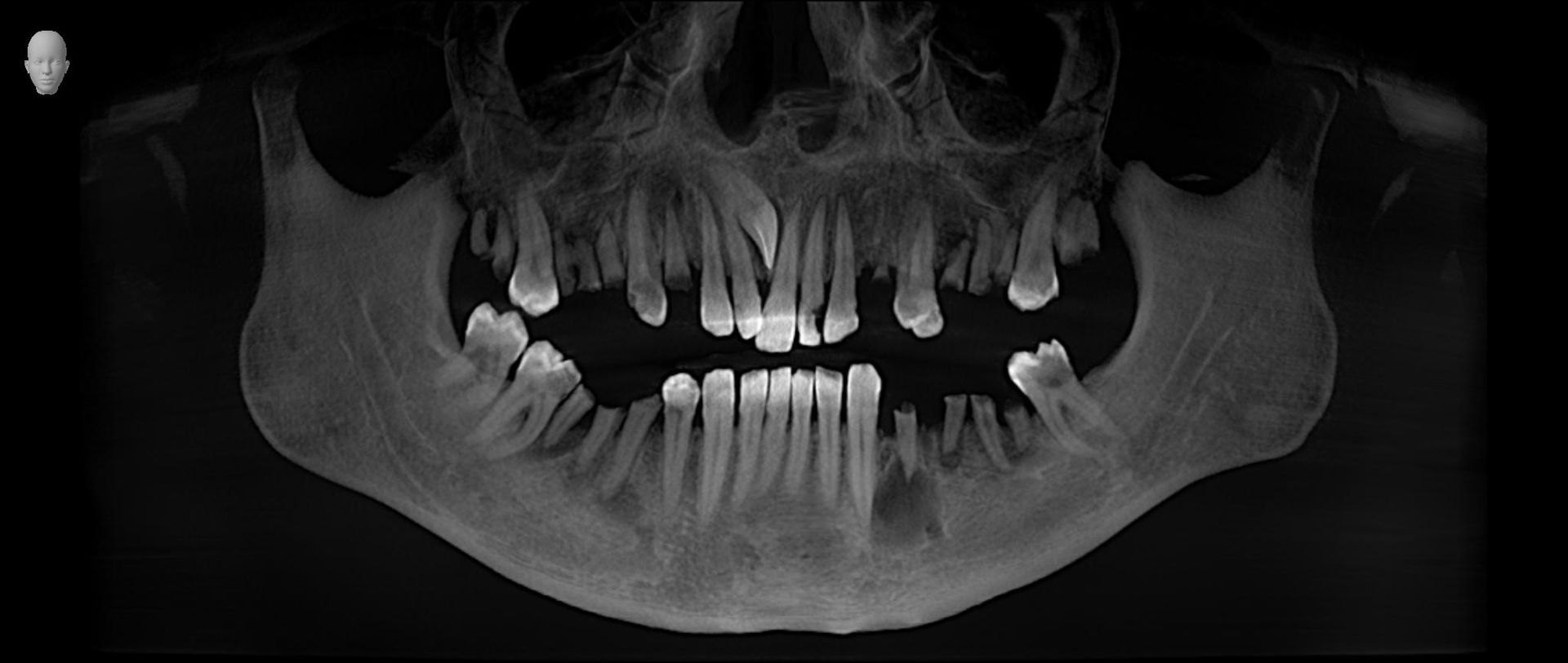 esame densità ossea mascellare