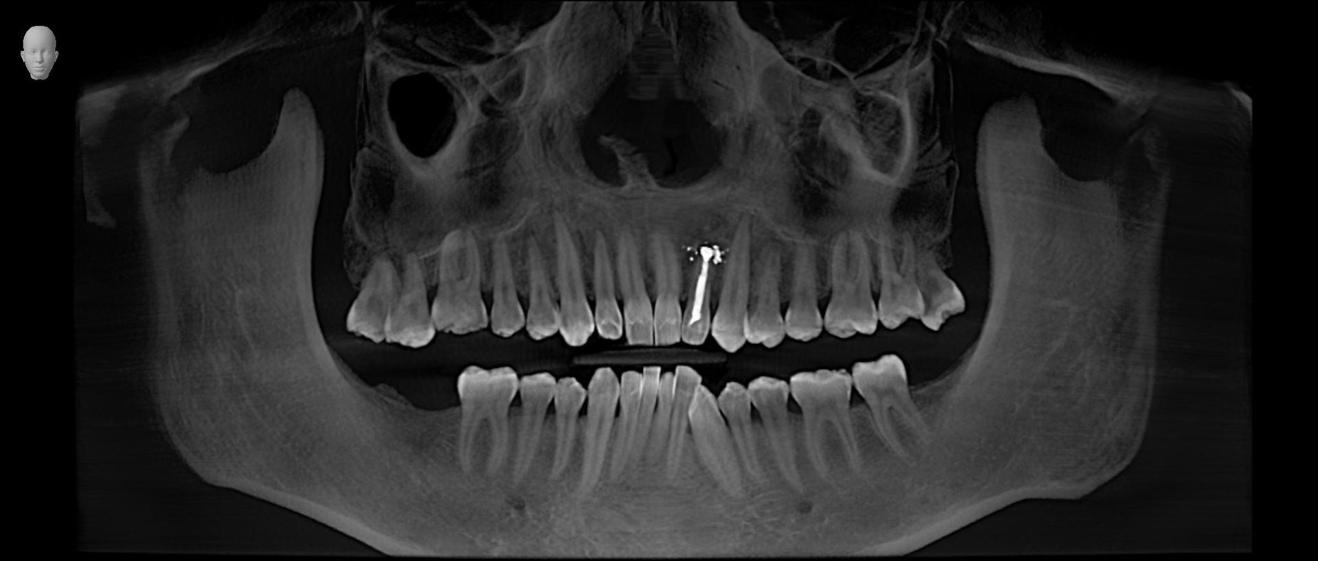 esame densità ossea mandibolare
