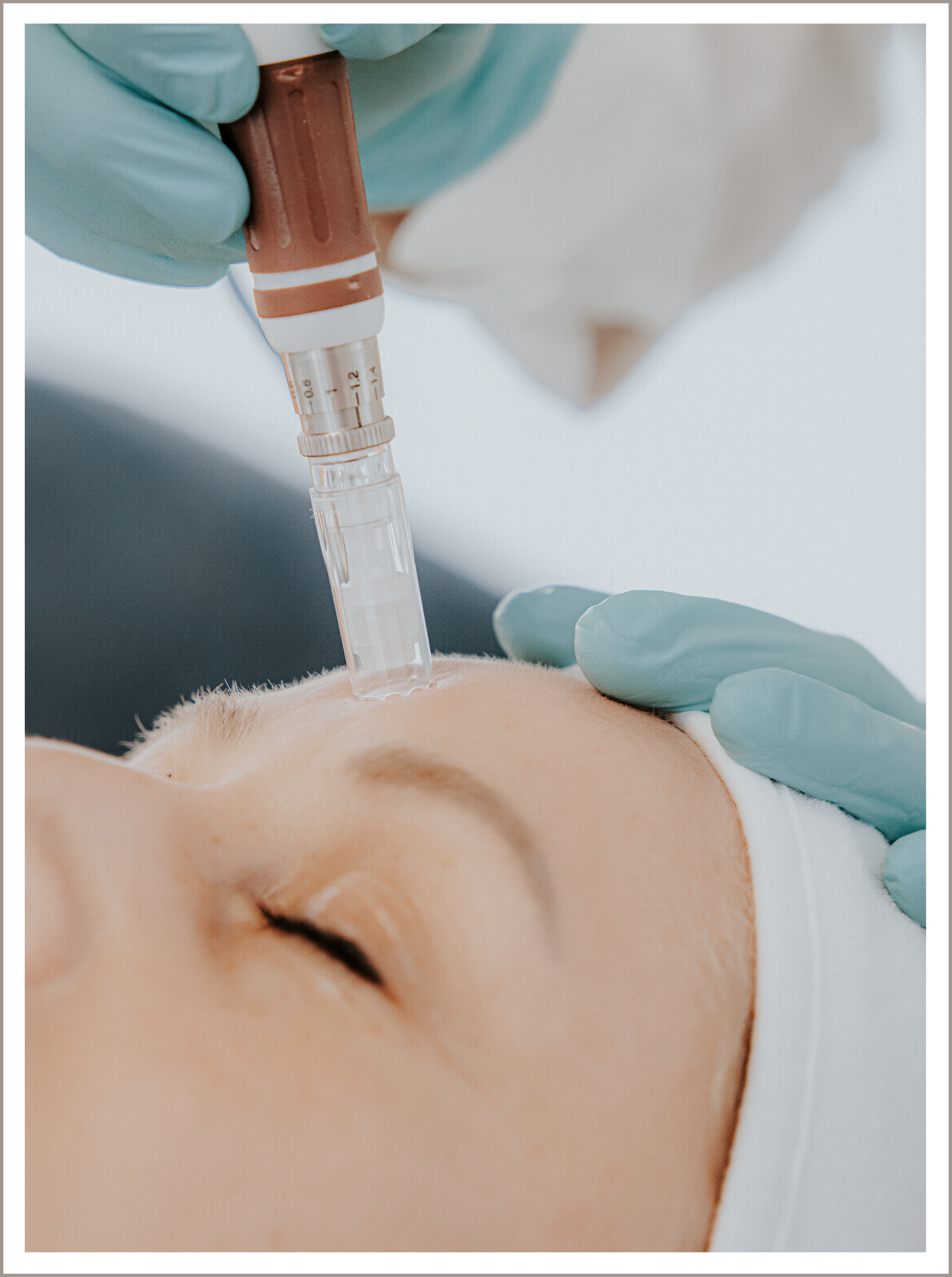 Eine Frau bekommt eine Mikronadelbehandlung im Gesicht.