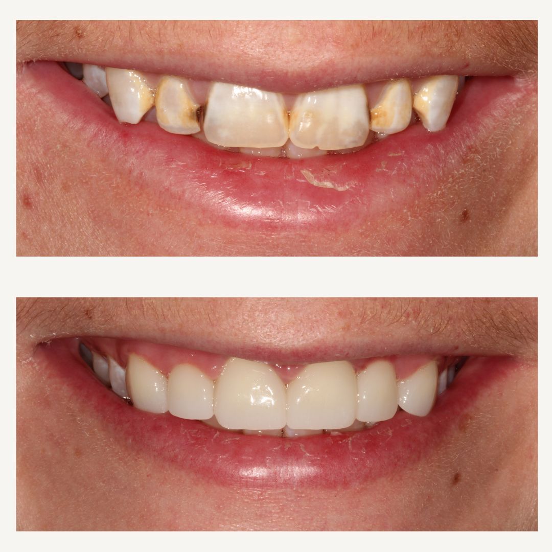 Orthodontics Before and After - Crown Point Dental