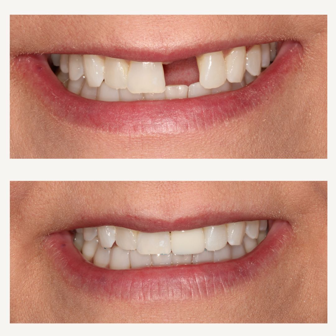 Orthodontics Before and After - Crown Point Dental