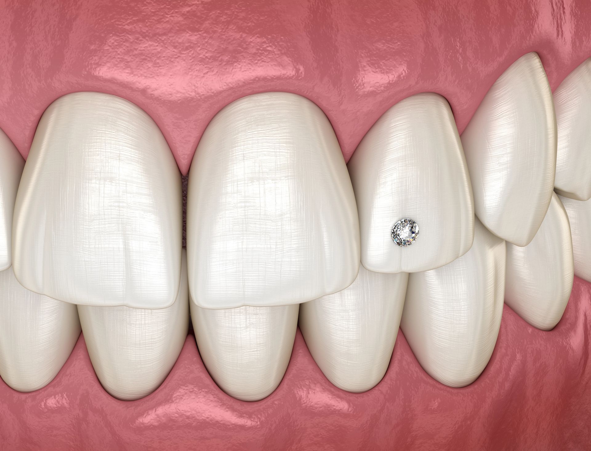Dental Implants - Crown Point Dental