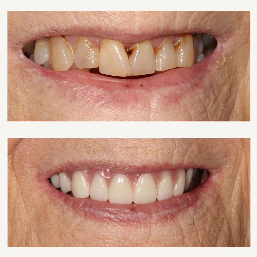 Crowns Before and After - Crown Point Dental