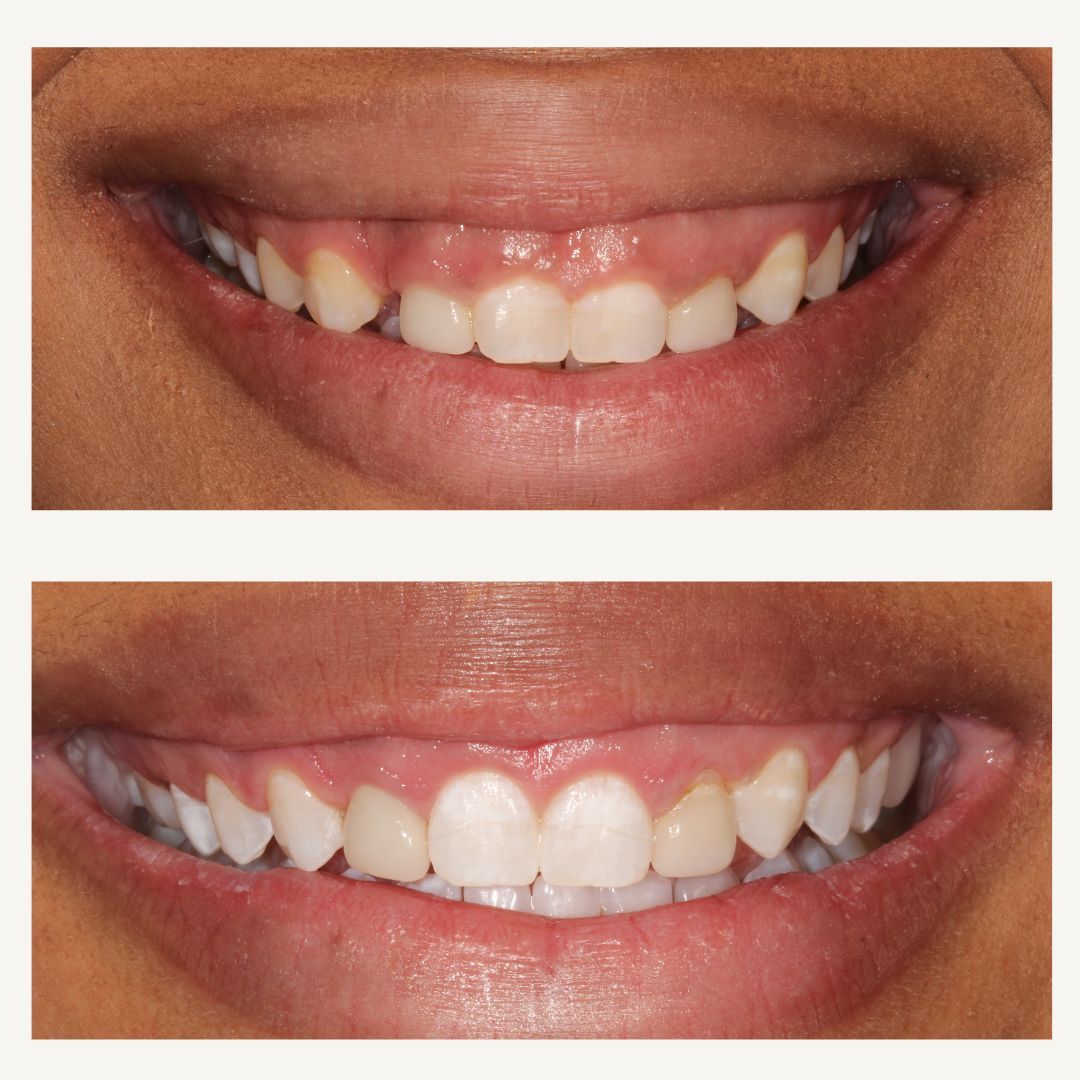 Crowns Before and After - Crown Point Dental