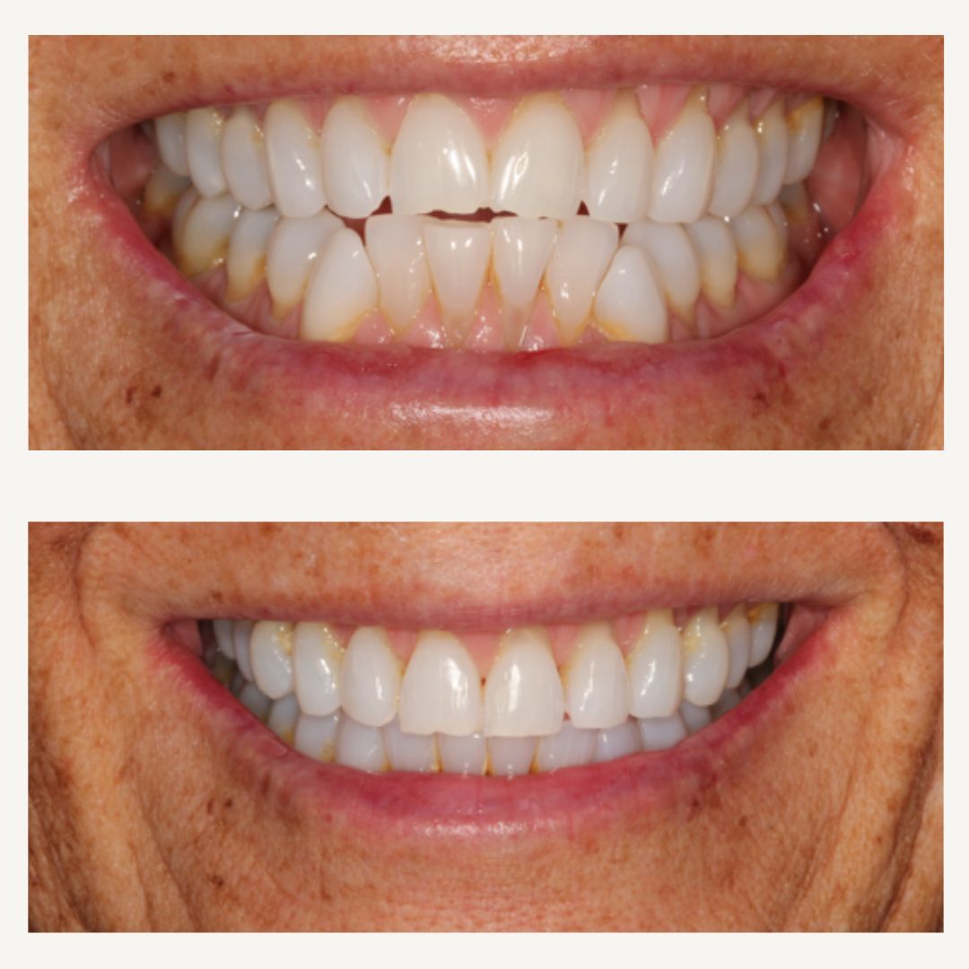 Orthodontics Before and After - Crown Point Dental