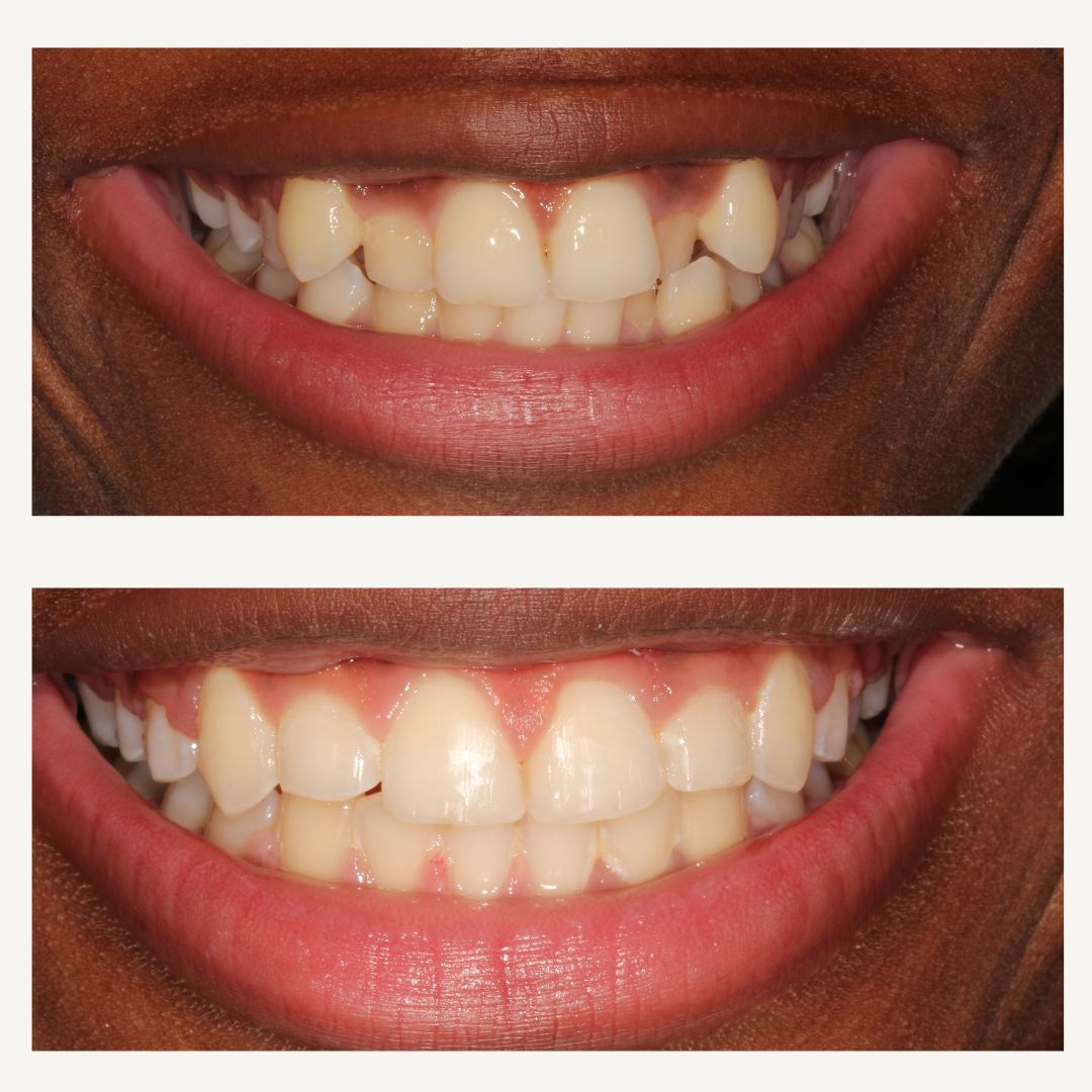 Orthodontics Before and After - Crown Point Dental