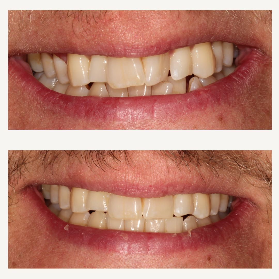 Orthodontics Before and After - Crown Point Dental