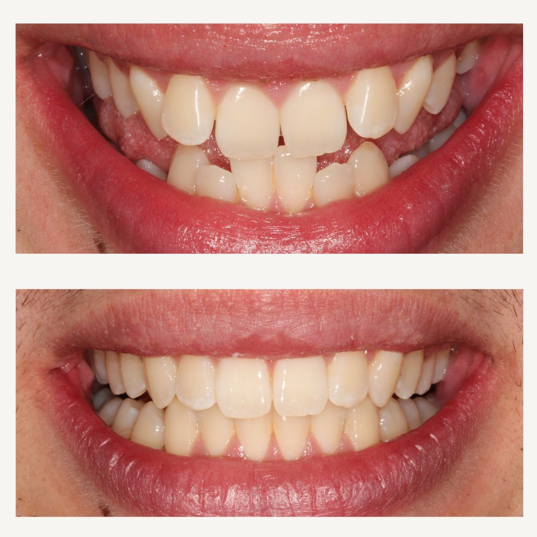 Orthodontics Before and After - Crown Point Dental