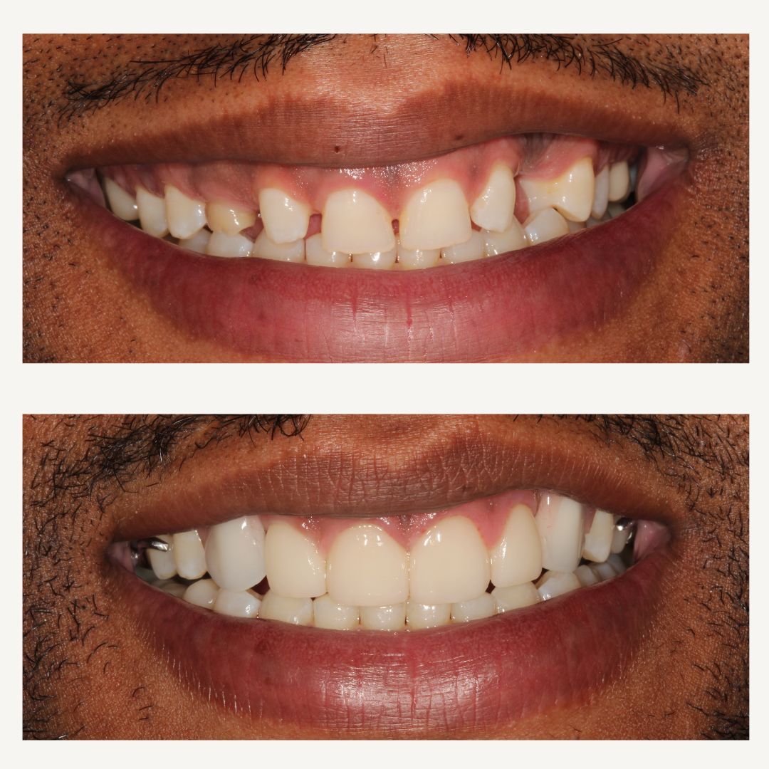 Orthodontics Before and After - Crown Point Dental