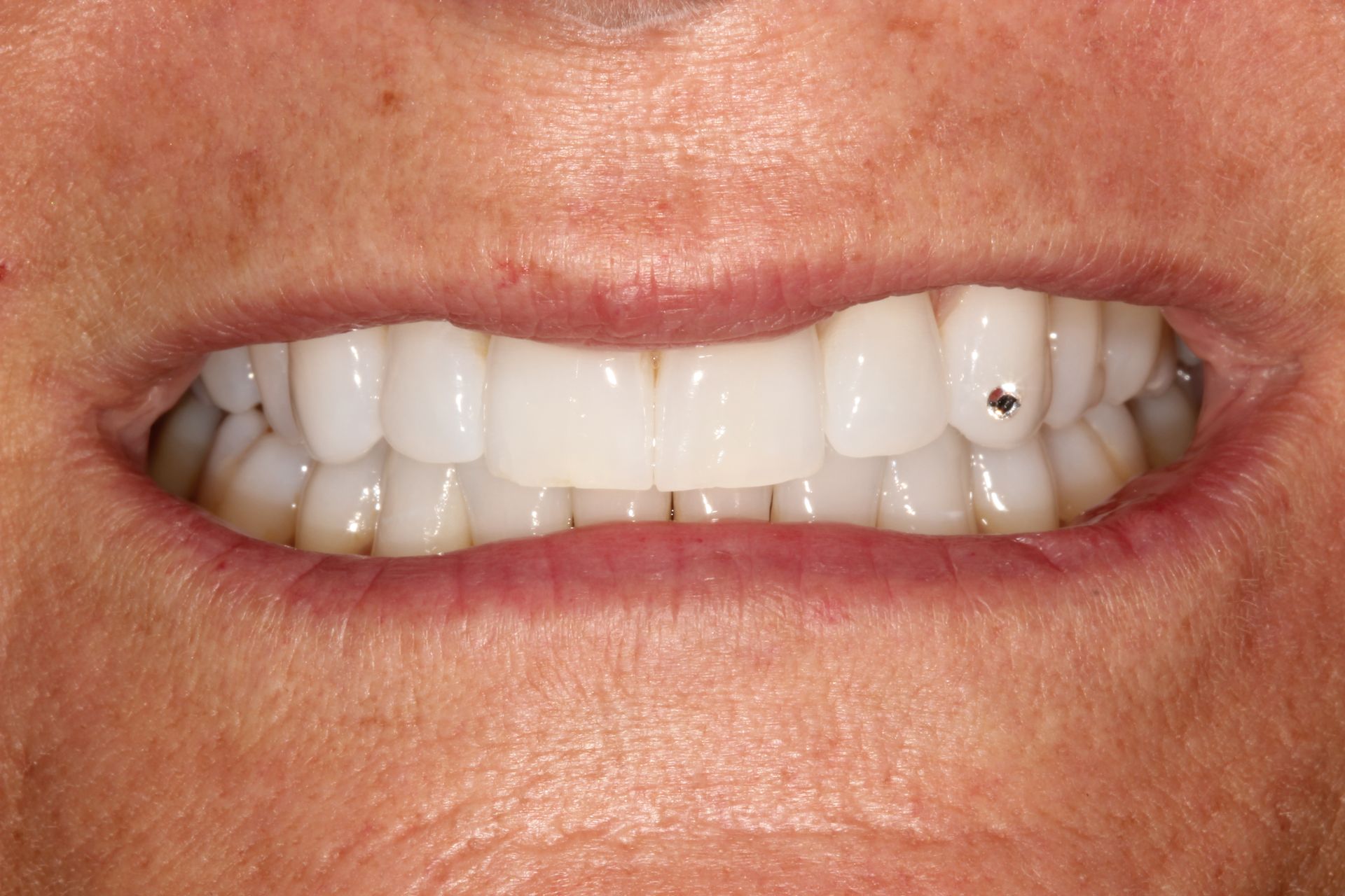 Dental Implants - Crown Point Dental