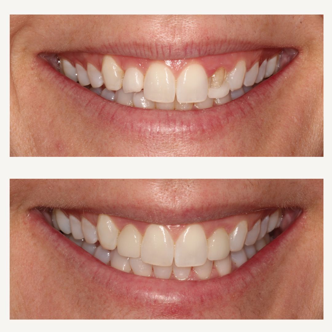 Orthodontics Before and After - Crown Point Dental