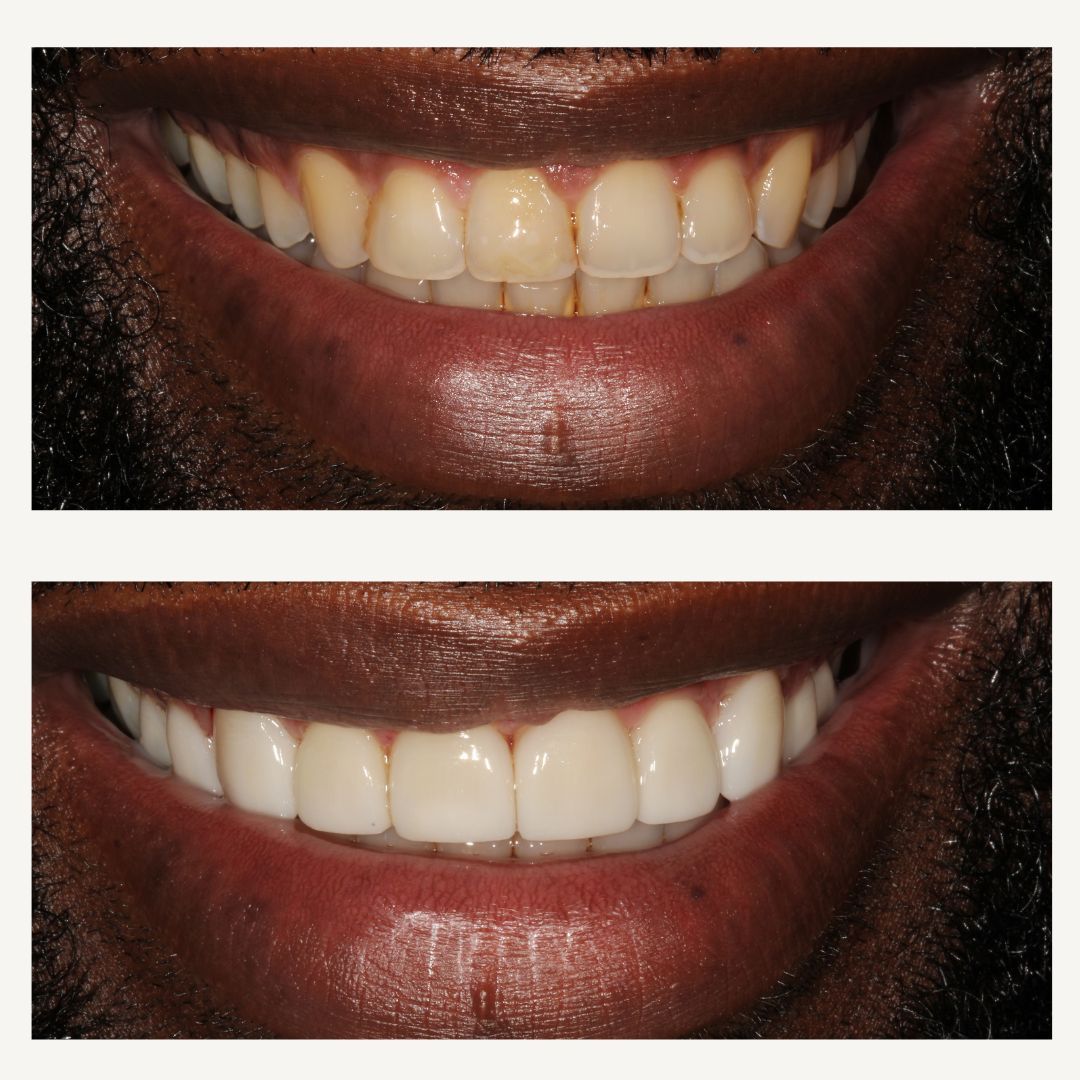 Orthodontics Before and After - Crown Point Dental