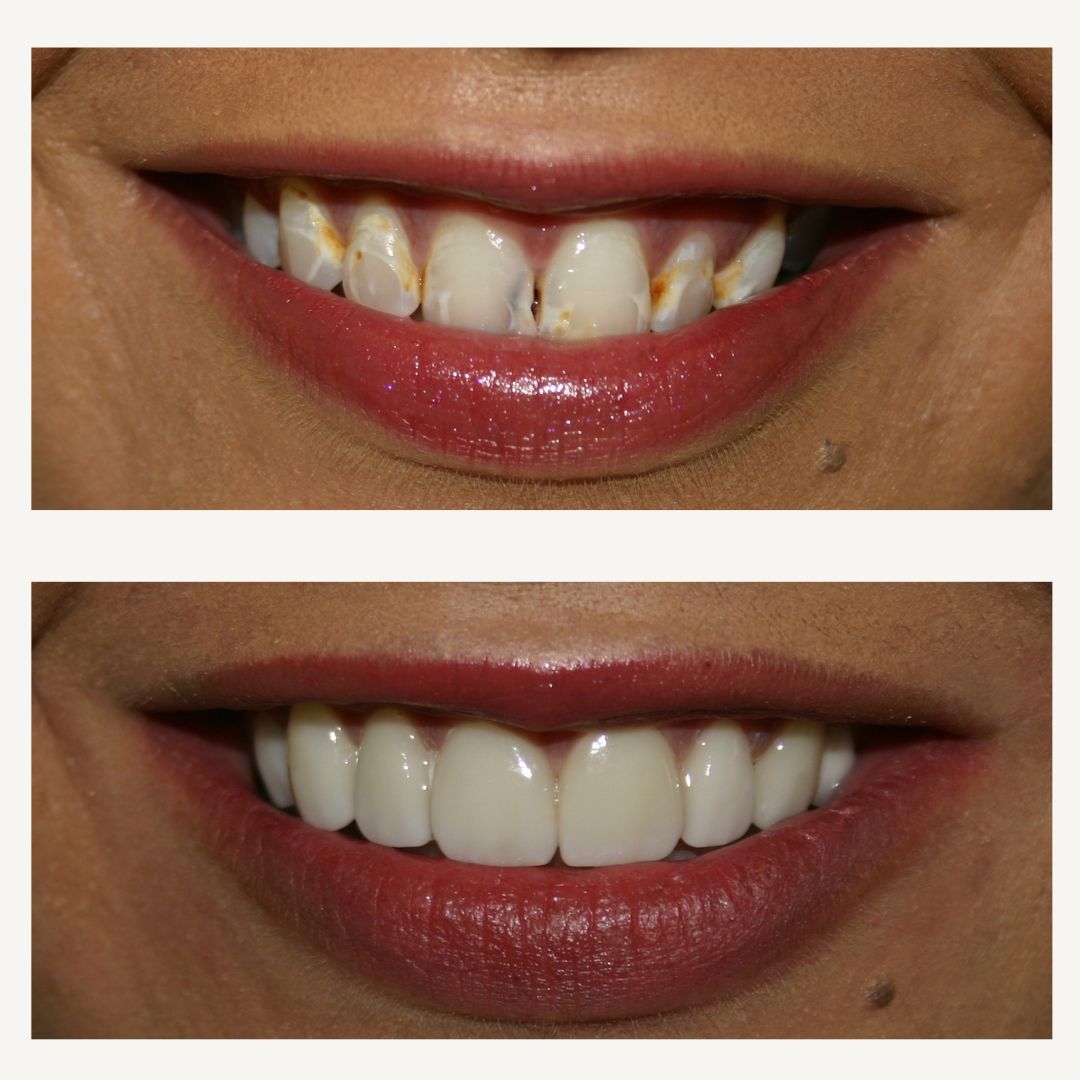 Orthodontics Before and After - Crown Point Dental