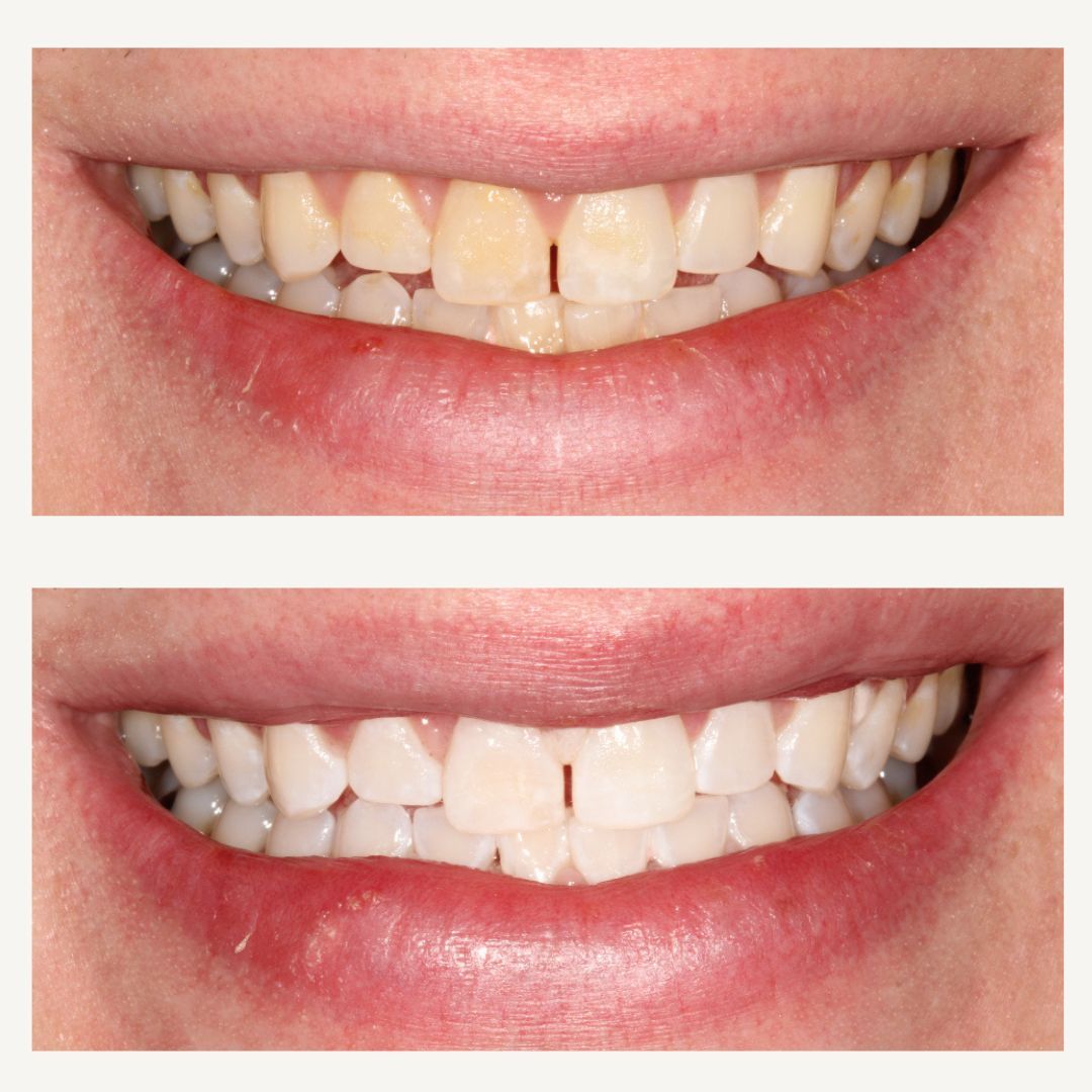 Orthodontics Before and After - Crown Point Dental