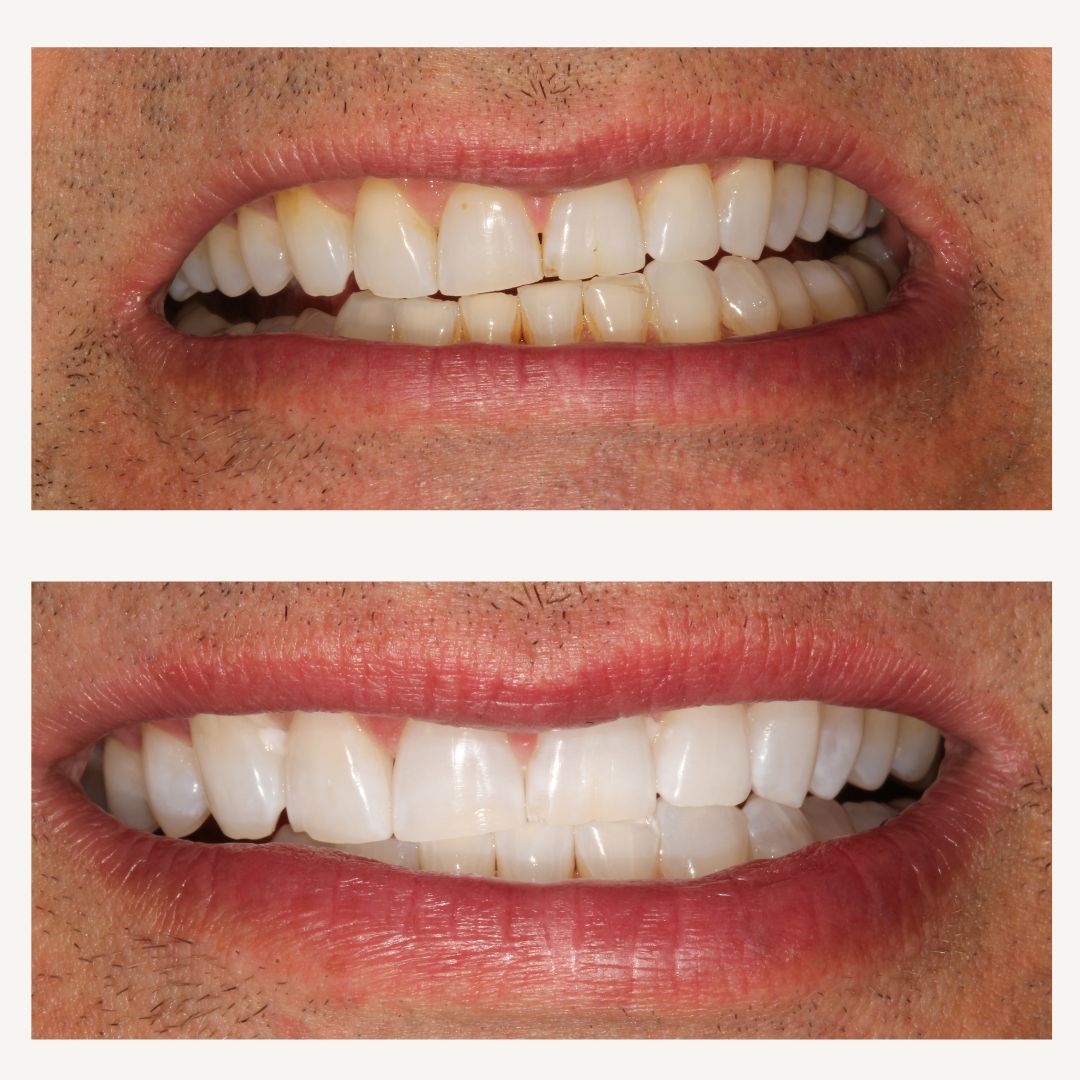 Orthodontics Before and After - Crown Point Dental