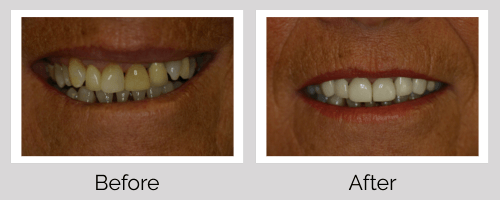 Crowns & Bridges Before and After - Crown Point Dental