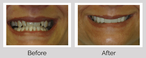Crowns & Bridges Before and After - Crown Point Dental