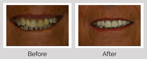 Crowns Before and After - Crown Point Dental