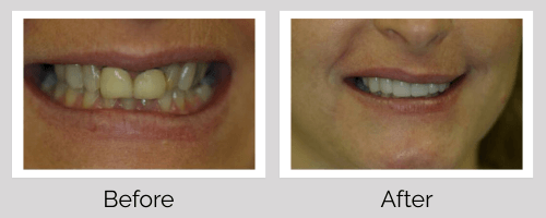 Crowns Before and After - Crown Point Dental