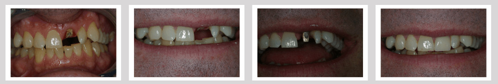Implants Before and After - Crown Point Dental