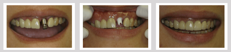 Implants Before and After - Crown Point Dental