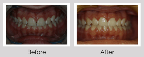 Invisalign/Orthodontics Before and After - Crown Point Dental