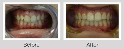 Invisalign/Orthodontics Before and After - Crown Point Dental