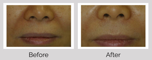 Juvederm Before and After - Crown Point Dental