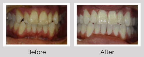Orthodontics Before and After - Crown Point Dental