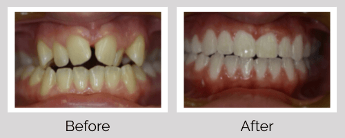 Orthodontics Before and After - Crown Point Dental